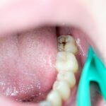 Ważne kroki w zapobieganiu próchnicy i chorobom przyzębia