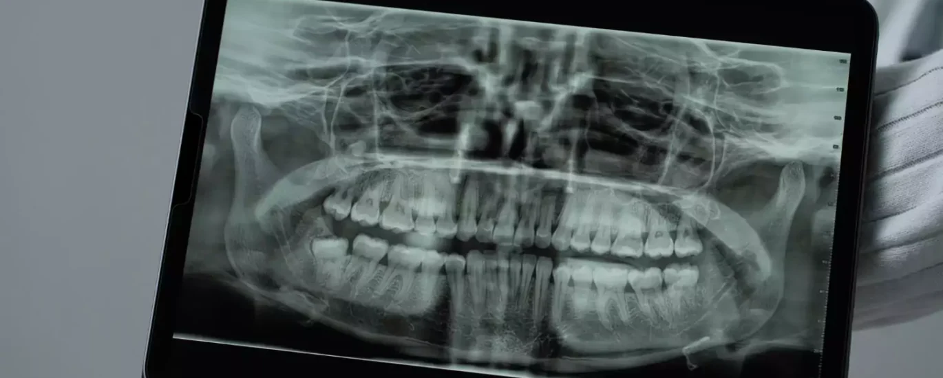 Nowoczesne zastosowania rentgenu w diagnostyce zębów