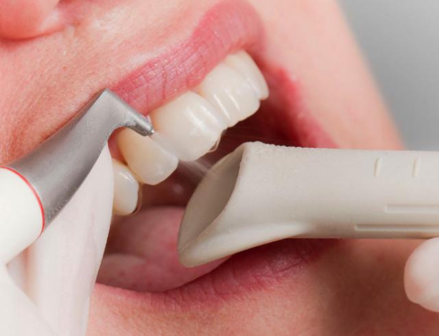 Odśwież swój uśmiech: jak piaskowanie pomaga utrzymać zęby w dobrej kondycji