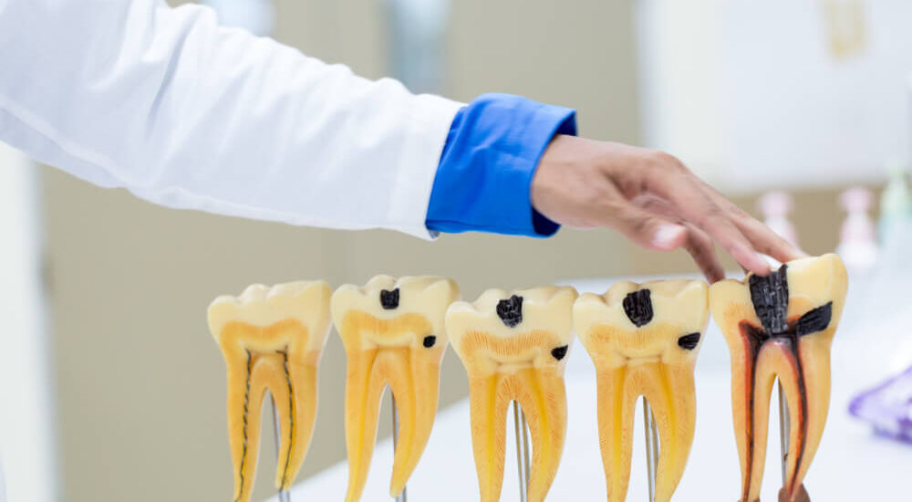 Jakie są techniki leczenia kanałowego?