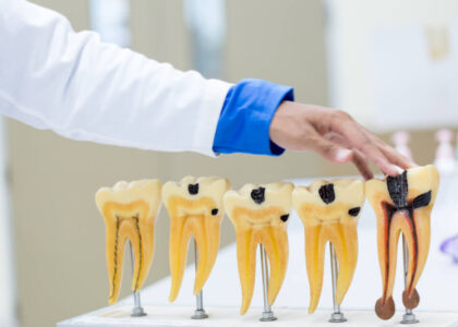 Jakie są techniki leczenia kanałowego?